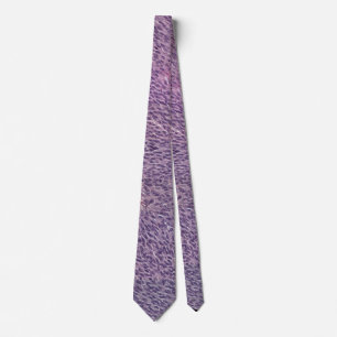 Spindle melanoma necktie slips
