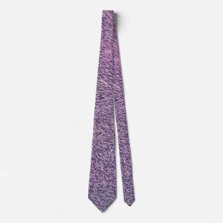 Spindle melanoma necktie slips