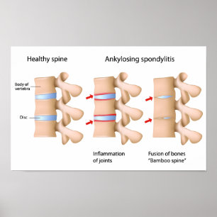 Spint Ankyloserande spondylit Poster