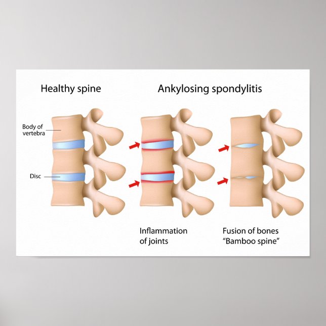 Spint Ankyloserande spondylit Poster (Framsidan)