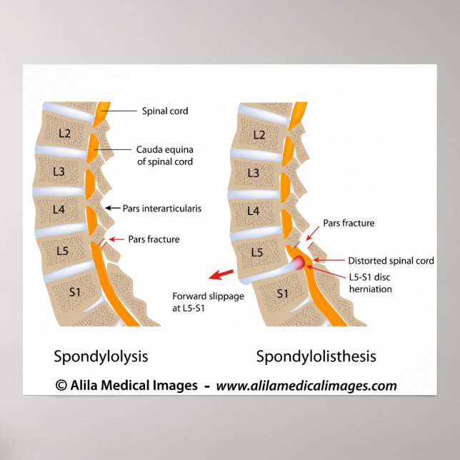 Spondylolys och spondylolistes, märkta poster (Framsidan)