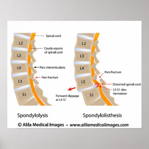Spondylolysis och spondylolisthesis som märks poster