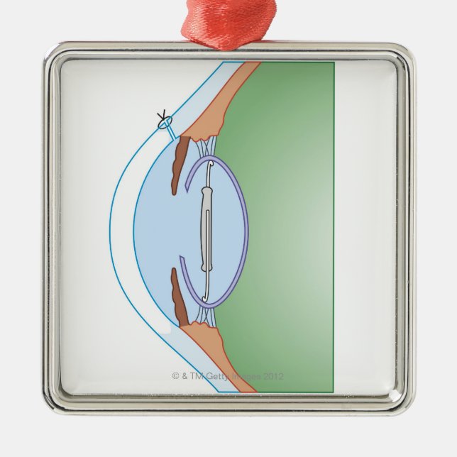Starrkirurgi Julgransprydnad Metall (Framsidan)