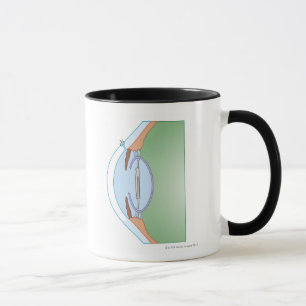 Starrkirurgi Mugg
