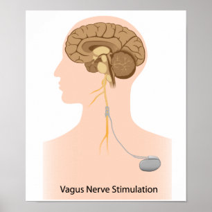 Stimulerande behandling med ventrombos Poster