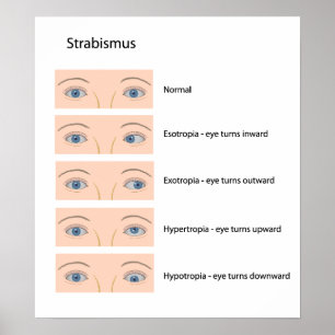 Strabismus öga defekt Poster