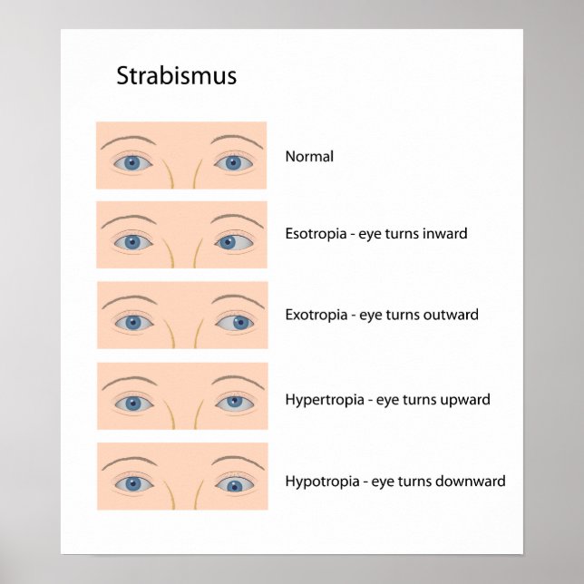 Strabismus öga defekt Poster (Framsidan)