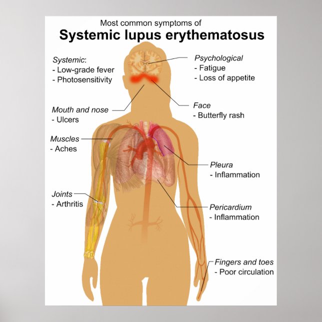 Symptom Chart of Systemic Lupus Erythematosus Poster (Framsidan)