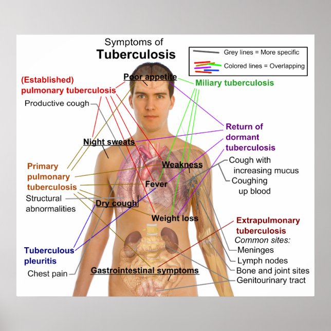 Symptom Diagram över tuberkulos hos människor Poster (Framsidan)