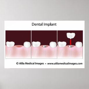 Tand- implantattillvägagångssättaffisch poster