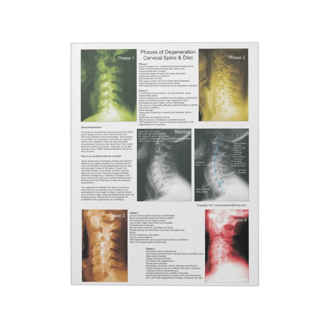 Tear off Pad Cervix Spinal Degeneration Anteckningsblock (Roterad)