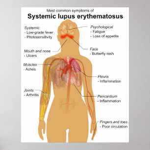 Tecknet kartlägger av Erythematosus för Systemic Poster