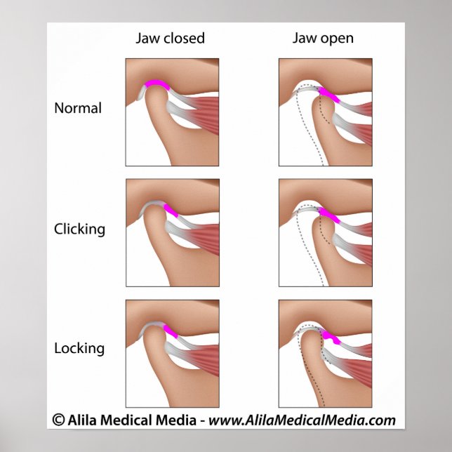 Temporomandibulär leddysfunktion, TMJ eller TMD Poster (Framsidan)