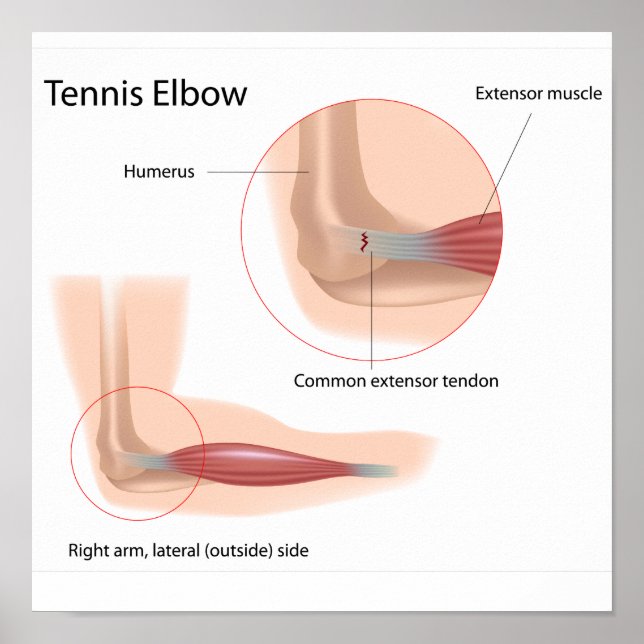 Tennis elbow Sport injury Poster (Framsidan)