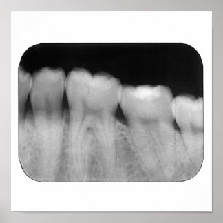 Teth med fyllning poster