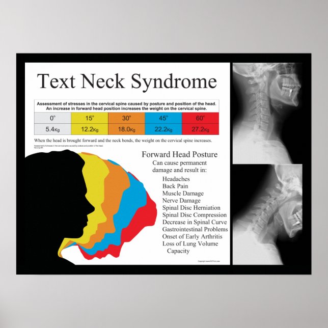 Text Nacke Syndrome Chiropraktic i kg Poster (Framsidan)