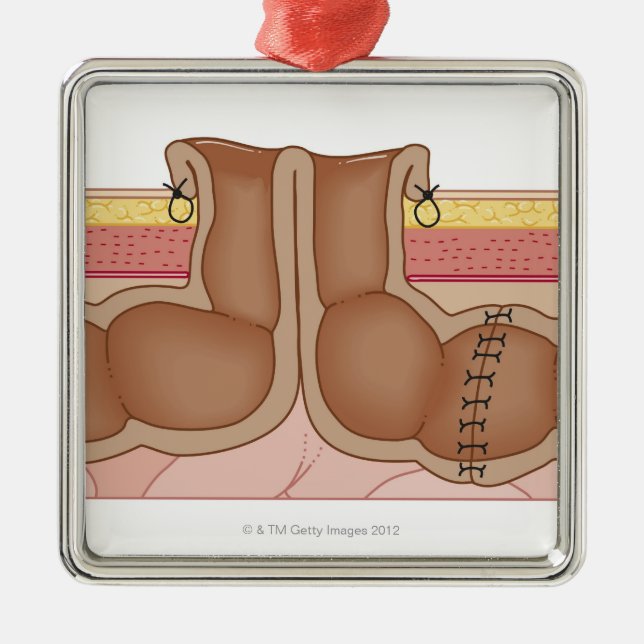 Tillfällig Colostomy Julgransprydnad Metall (Framsidan)