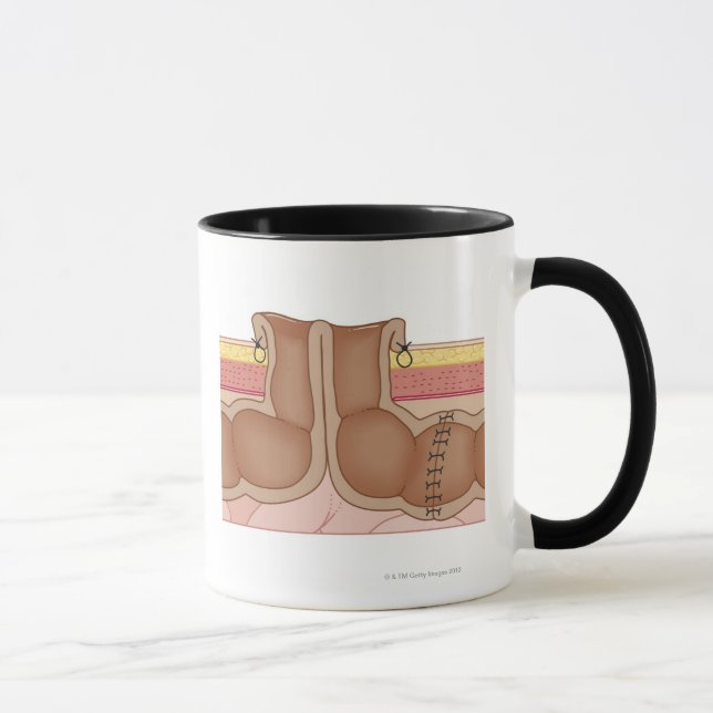 Tillfällig Colostomy Mugg (Höger)