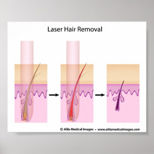 Tillvägagångssätt för laser-hårborttagning poster