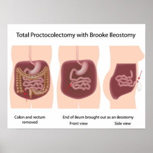 Total proctokolektomi med Brooke ileostomy poster