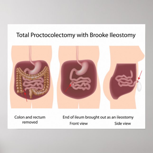 Total proctokolektomi med Brooke ileostomy poster (Framsidan)