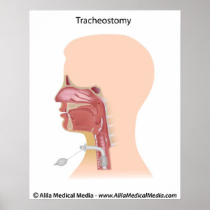 Tracheostomy teckning. poster