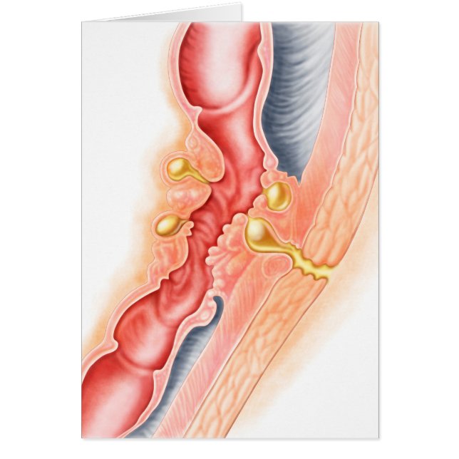 Utvecklingen av Fistula Hälsningskort (Framsidan)