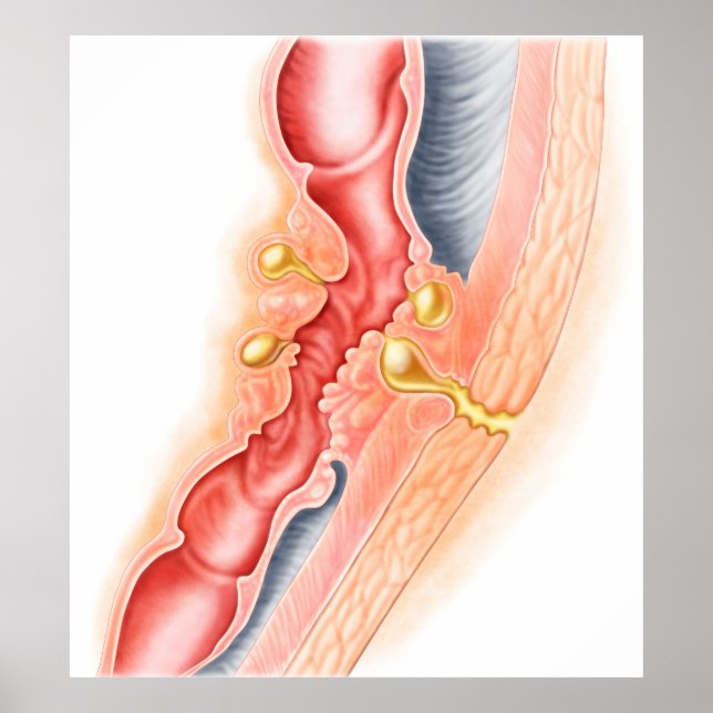 Utvecklingen av Fistula Poster (Framsidan)
