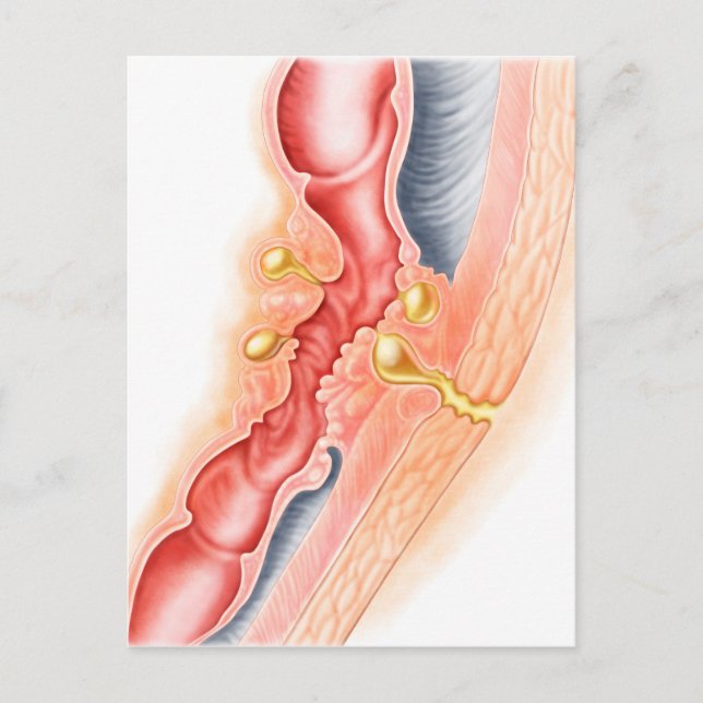 Utvecklingen av Fistula Vykort (Framsida)