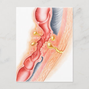 Utvecklingen av Fistula Vykort