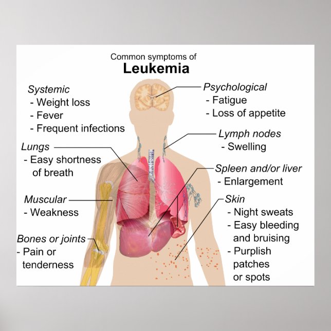 Vanliga symtom Diagram över leukemi Blodcancer Poster (Framsidan)