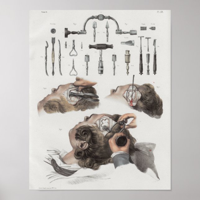 Vintage av hjärnkirurgi Instruments Anatomy Print Poster (Framsidan)