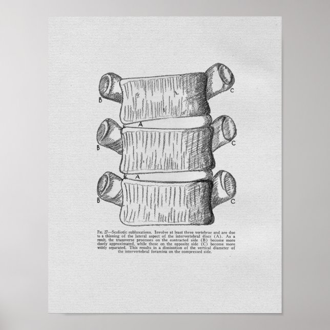 Vintagen Chiropraktik Vertebral Subluxation Poster (Framsidan)