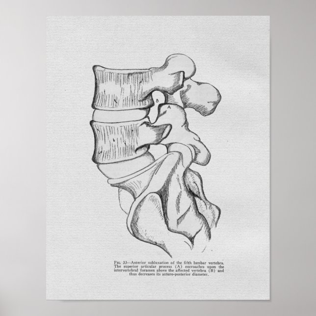 Vintagen Chiropraktik Vertebral Subluxation Poster (Framsidan)