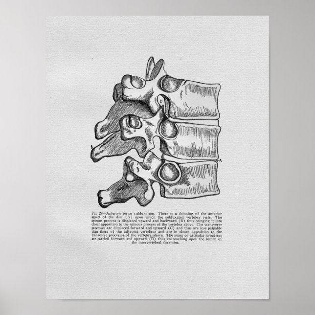 Vintagen Chiropraktik Vertebral Subluxation Poster (Framsidan)