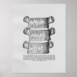 Vintagen Chiropraktik Vertebral Subluxation Poster