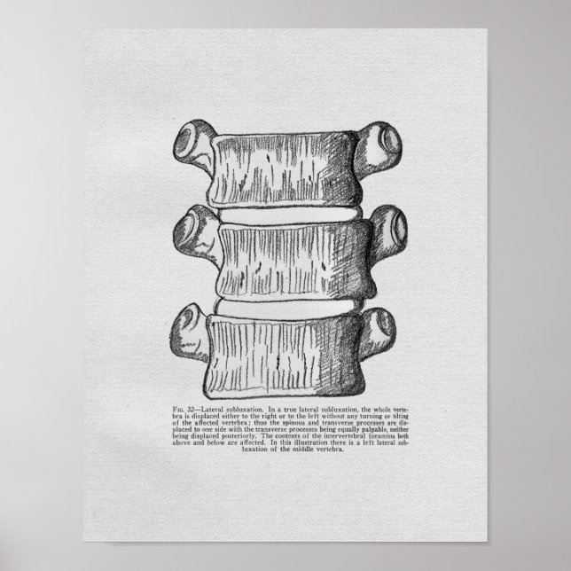 Vintagen Chiropraktik Vertebral Subluxation Poster (Framsidan)