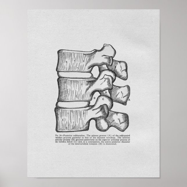 Vintagen Chiropraktik Vertebral Subluxation Poster (Framsidan)