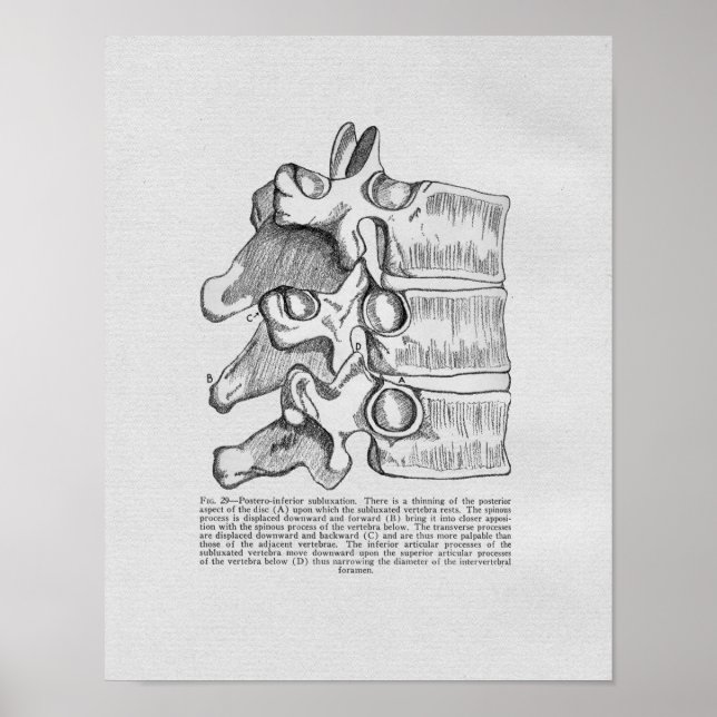 Vintagen Chiropraktik Vertebral Subluxation Poster (Framsidan)
