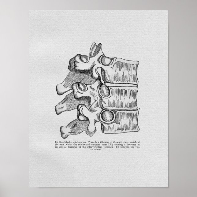 Vintagen Chiropraktik Vertebral Subluxation Poster (Framsidan)