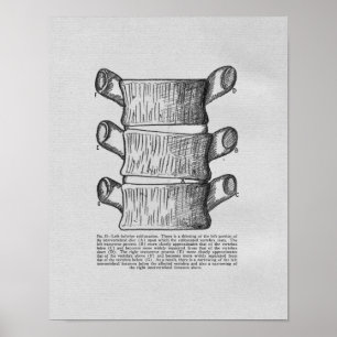 Vintagen Chiropraktik Vertebral Subluxation Poster