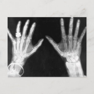 X-Ray Skeleton Händer & Jewelry - B&W Vykort