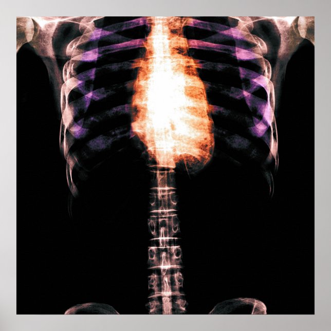 X-RAY SKELETON TORSO RIBS - ORIGINAL POSTER (Framsidan)