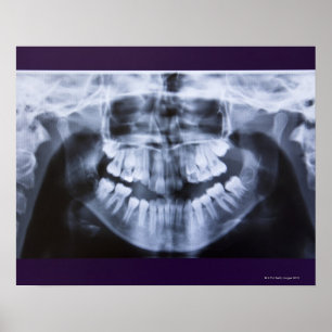 Xray of a girl jawline taken with a panorama poster