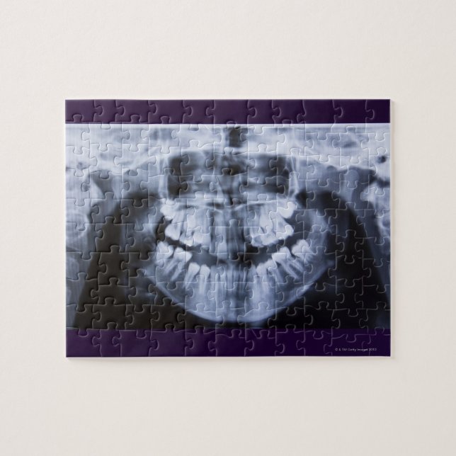 Xray of a girl jawline taken with a panorama pussel (Horisontell)