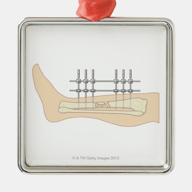 Yttre Fixator Julgransprydnad Metall (Framsidan)